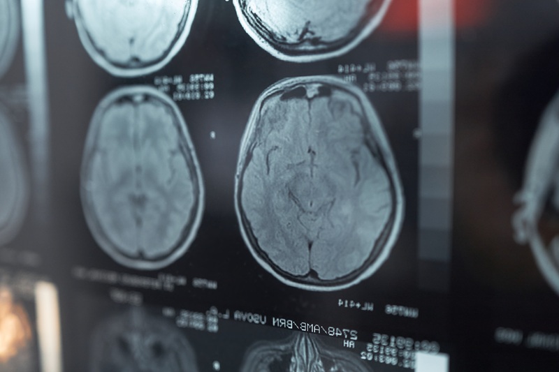 Brain scans looking for injuries after a car accident